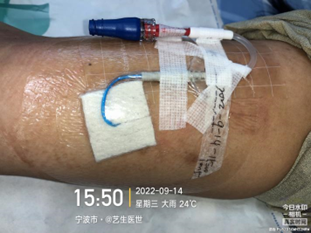 为什么用银敷每天都在换药，这些治疗性敷料你用对了吗？_https://www.jmylbn.com_新闻资讯_第9张