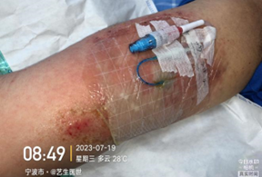 为什么用银敷每天都在换药，这些治疗性敷料你用对了吗？_https://www.jmylbn.com_新闻资讯_第15张