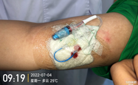 为什么用银敷每天都在换药，这些治疗性敷料你用对了吗？_https://www.jmylbn.com_新闻资讯_第14张