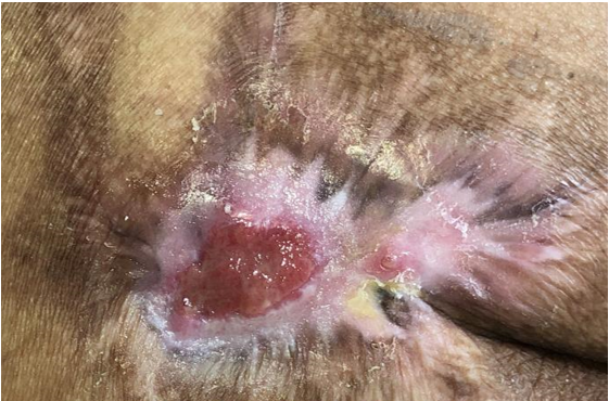 怎么促进vsd伤口愈合碗口大的压疮靠换药能够愈合吗？_https://www.jmylbn.com_新闻资讯_第35张