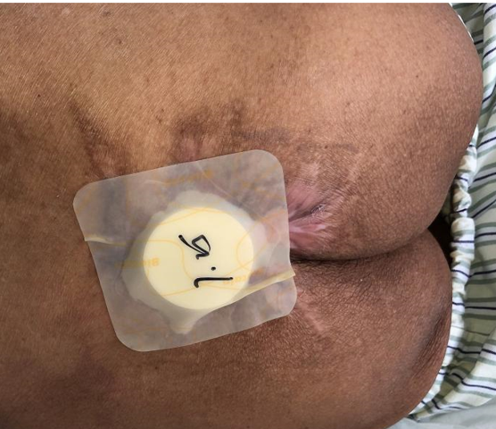 怎么促进vsd伤口愈合碗口大的压疮靠换药能够愈合吗？_https://www.jmylbn.com_新闻资讯_第36张