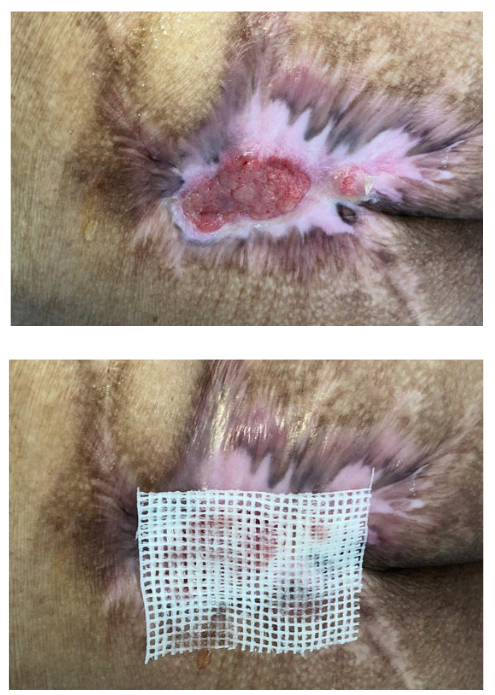 怎么促进vsd伤口愈合碗口大的压疮靠换药能够愈合吗？_https://www.jmylbn.com_新闻资讯_第30张