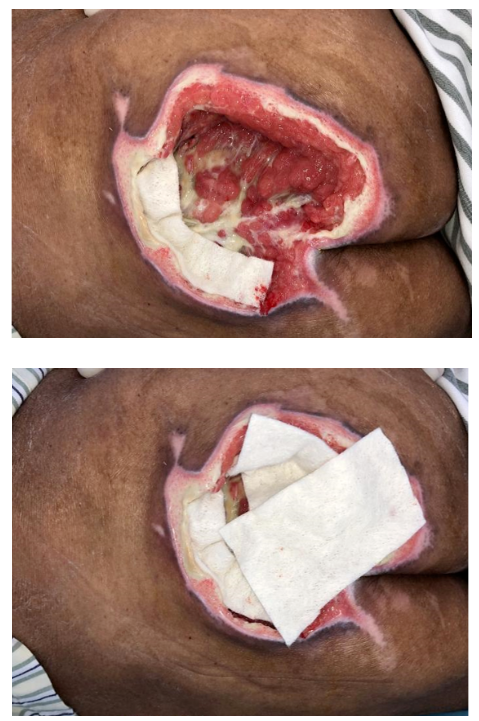 怎么促进vsd伤口愈合碗口大的压疮靠换药能够愈合吗？_https://www.jmylbn.com_新闻资讯_第12张