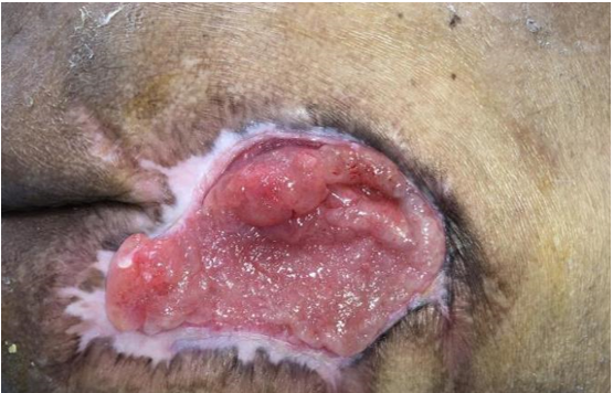 怎么促进vsd伤口愈合碗口大的压疮靠换药能够愈合吗？_https://www.jmylbn.com_新闻资讯_第21张