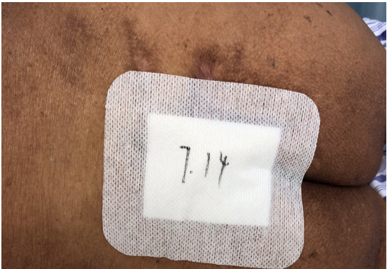 怎么促进vsd伤口愈合碗口大的压疮靠换药能够愈合吗？_https://www.jmylbn.com_新闻资讯_第31张