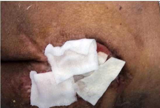 怎么促进vsd伤口愈合碗口大的压疮靠换药能够愈合吗？_https://www.jmylbn.com_新闻资讯_第25张