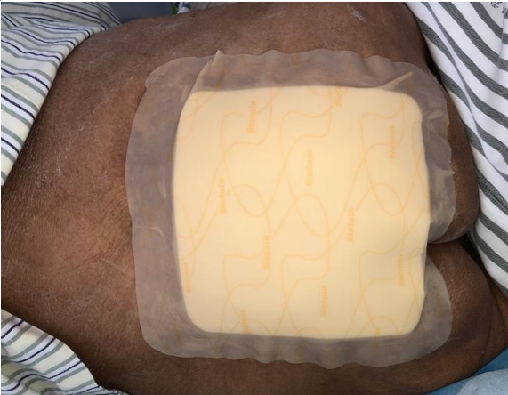 怎么促进vsd伤口愈合碗口大的压疮靠换药能够愈合吗？_https://www.jmylbn.com_新闻资讯_第13张