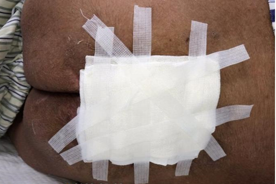 怎么促进vsd伤口愈合碗口大的压疮靠换药能够愈合吗？_https://www.jmylbn.com_新闻资讯_第26张