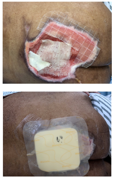 怎么促进vsd伤口愈合碗口大的压疮靠换药能够愈合吗？_https://www.jmylbn.com_新闻资讯_第17张