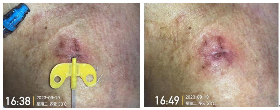 为什么输液要盖块纱布输液港维护周期，这 6 个时间点必须注意！_https://www.jmylbn.com_新闻资讯_第8张