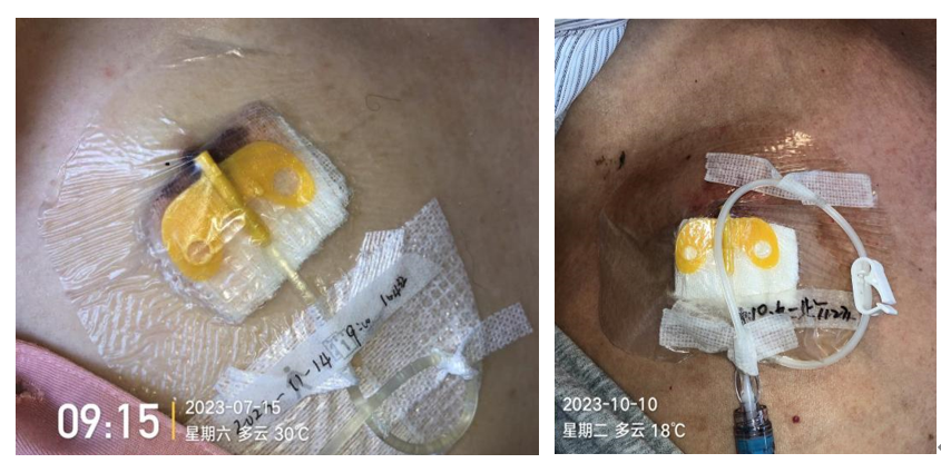 为什么输液要盖块纱布输液港维护周期，这 6 个时间点必须注意！_https://www.jmylbn.com_新闻资讯_第9张