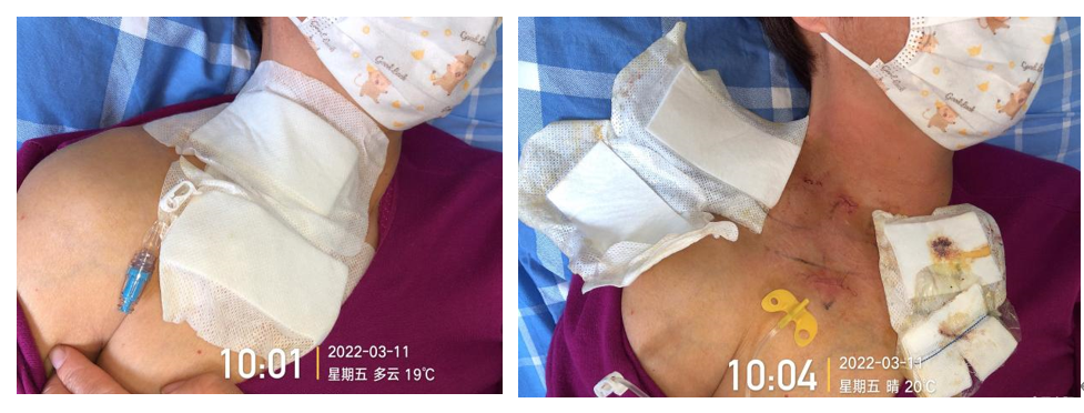 为什么输液要盖块纱布输液港维护周期，这 6 个时间点必须注意！_https://www.jmylbn.com_新闻资讯_第1张