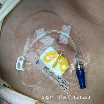 为什么输液要盖块纱布输液港维护周期，这 6 个时间点必须注意！_https://www.jmylbn.com_新闻资讯_第6张