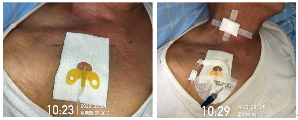 为什么输液要盖块纱布输液港维护周期，这 6 个时间点必须注意！_https://www.jmylbn.com_新闻资讯_第4张