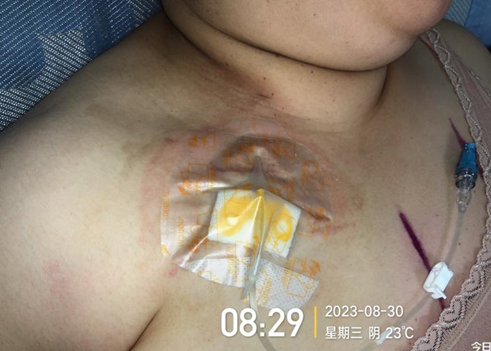 为什么输液要盖块纱布输液港维护周期，这 6 个时间点必须注意！_https://www.jmylbn.com_新闻资讯_第11张