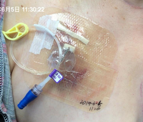 为什么输液要盖块纱布输液港维护周期，这 6 个时间点必须注意！_https://www.jmylbn.com_新闻资讯_第14张