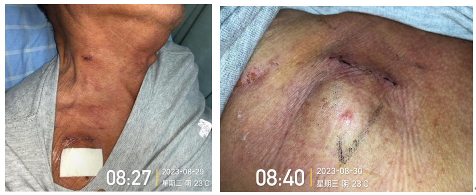 为什么输液要盖块纱布输液港维护周期，这 6 个时间点必须注意！_https://www.jmylbn.com_新闻资讯_第5张