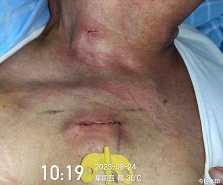 为什么输液要盖块纱布输液港维护周期，这 6 个时间点必须注意！_https://www.jmylbn.com_新闻资讯_第3张