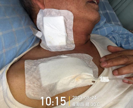 为什么输液要盖块纱布输液港维护周期，这 6 个时间点必须注意！_https://www.jmylbn.com_新闻资讯_第2张