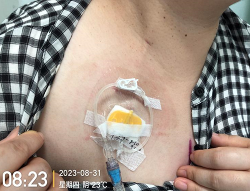 为什么输液要盖块纱布输液港维护周期，这 6 个时间点必须注意！_https://www.jmylbn.com_新闻资讯_第13张