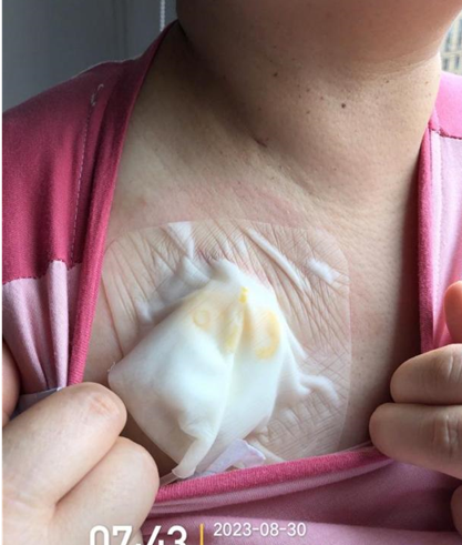 为什么输液要盖块纱布输液港维护周期，这 6 个时间点必须注意！_https://www.jmylbn.com_新闻资讯_第10张