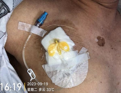 为什么输液要盖块纱布输液港维护周期，这 6 个时间点必须注意！_https://www.jmylbn.com_新闻资讯_第7张