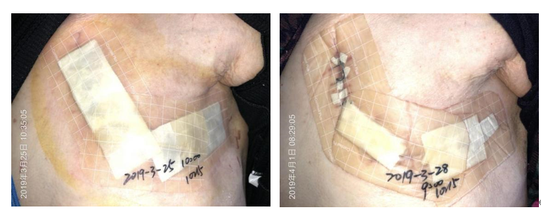 人工敷料怎么照顾伤口外科伤口换药经验，3 个字总结，看完都收藏了_https://www.jmylbn.com_新闻资讯_第4张