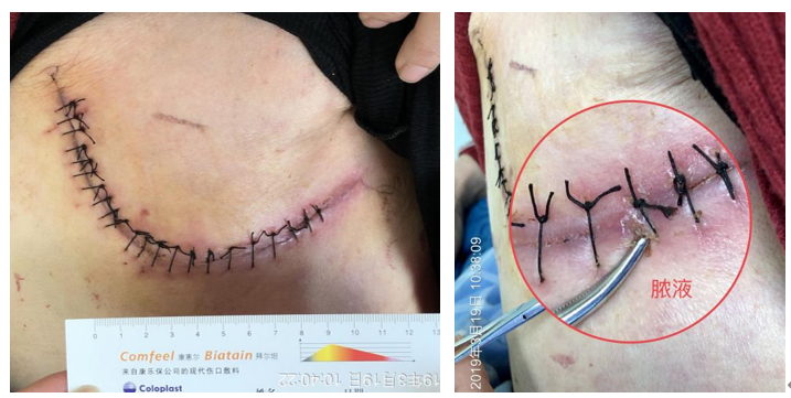 人工敷料怎么照顾伤口外科伤口换药经验，3 个字总结，看完都收藏了_https://www.jmylbn.com_新闻资讯_第2张