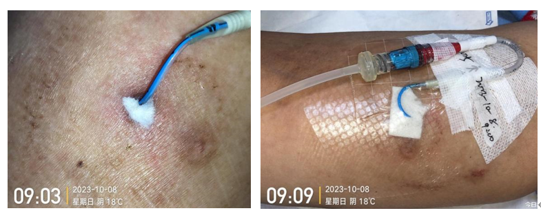 人工敷料怎么照顾伤口外科伤口换药经验，3 个字总结，看完都收藏了_https://www.jmylbn.com_新闻资讯_第16张