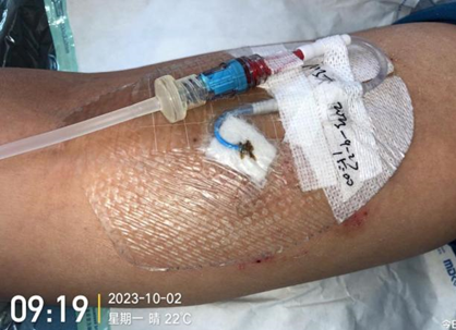 人工敷料怎么照顾伤口外科伤口换药经验，3 个字总结，看完都收藏了_https://www.jmylbn.com_新闻资讯_第13张