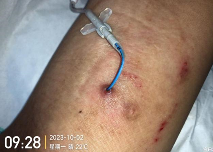 人工敷料怎么照顾伤口外科伤口换药经验，3 个字总结，看完都收藏了_https://www.jmylbn.com_新闻资讯_第15张