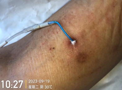 人工敷料怎么照顾伤口外科伤口换药经验，3 个字总结，看完都收藏了_https://www.jmylbn.com_新闻资讯_第9张