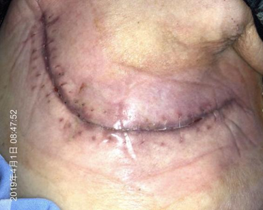 人工敷料怎么照顾伤口外科伤口换药经验，3 个字总结，看完都收藏了_https://www.jmylbn.com_新闻资讯_第5张