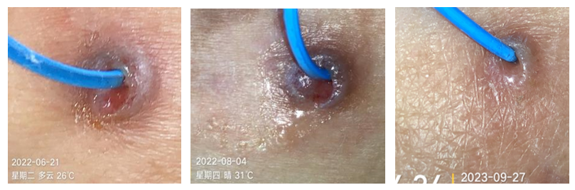 人工敷料怎么照顾伤口外科伤口换药经验，3 个字总结，看完都收藏了_https://www.jmylbn.com_新闻资讯_第6张