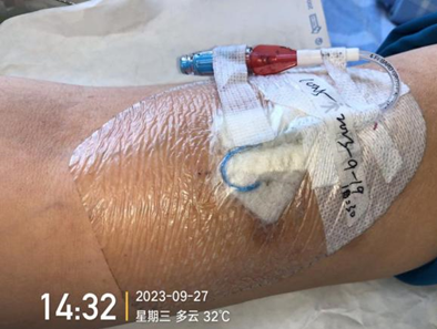 人工敷料怎么照顾伤口外科伤口换药经验，3 个字总结，看完都收藏了_https://www.jmylbn.com_新闻资讯_第11张