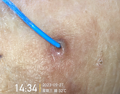 人工敷料怎么照顾伤口外科伤口换药经验，3 个字总结，看完都收藏了_https://www.jmylbn.com_新闻资讯_第12张