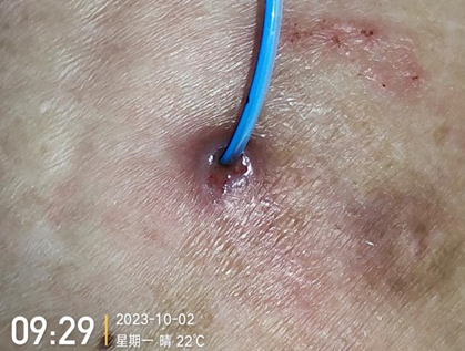 人工敷料怎么照顾伤口外科伤口换药经验，3 个字总结，看完都收藏了_https://www.jmylbn.com_新闻资讯_第14张