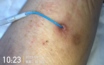 人工敷料怎么照顾伤口外科伤口换药经验，3 个字总结，看完都收藏了_https://www.jmylbn.com_新闻资讯_第8张