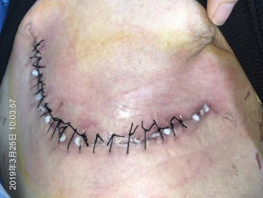 人工敷料怎么照顾伤口外科伤口换药经验，3 个字总结，看完都收藏了_https://www.jmylbn.com_新闻资讯_第3张