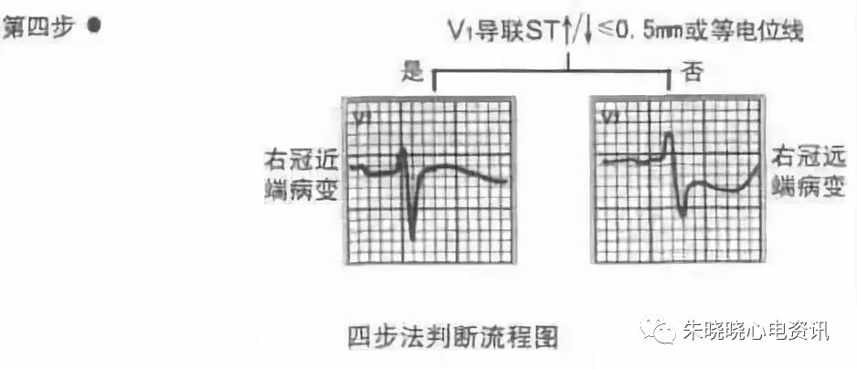 心梗时快速判断梗死部位和范围，实用！