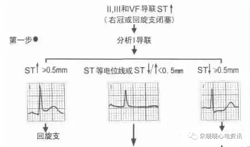 心梗时快速判断梗死部位和范围，实用！