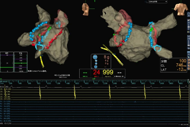 关于房颤的核心知识点，你都掌握了吗？