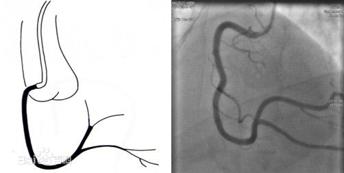 冠状动脉造影？没那么难，这样教你弄懂！