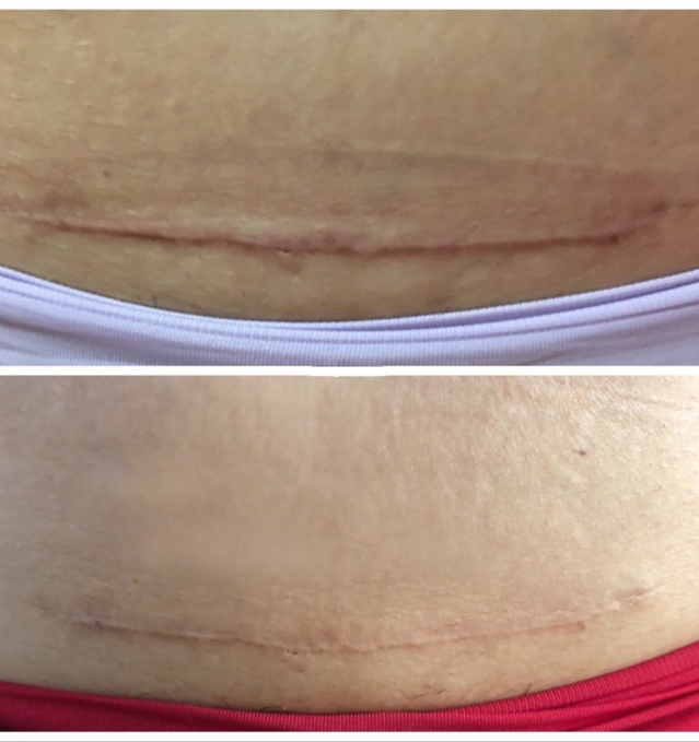 二氧化碳(co2)激光治疗是什么革新妇科治疗领域：CO2点阵激光技术引领无痛高效康复新时代_https://www.jmylbn.com_新闻资讯_第21张