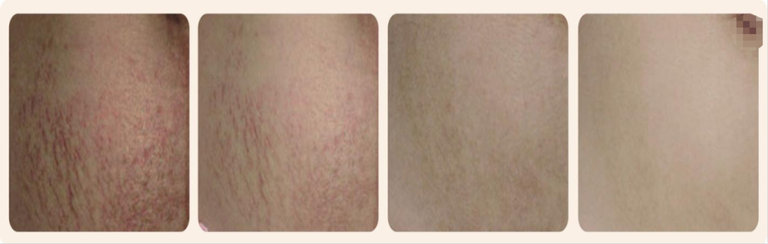 二氧化碳(co2)激光治疗是什么革新妇科治疗领域：CO2点阵激光技术引领无痛高效康复新时代_https://www.jmylbn.com_新闻资讯_第18张