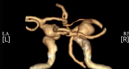 九旬老人危症叠加 | 中山一院广西医院神经外科微创手术拆除颅内“定时炸弹”