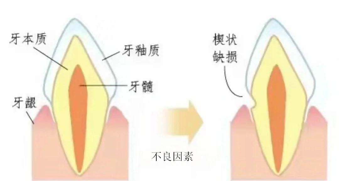 【健康科普】“医生，我的牙上有一条沟”