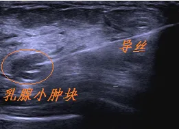 乳腺定位针怎么放新技术上线 ｜ 让早期乳腺癌无处遁形——超声引导下导丝定位“捕捉”乳腺小结节_https://www.jmylbn.com_新闻资讯_第7张