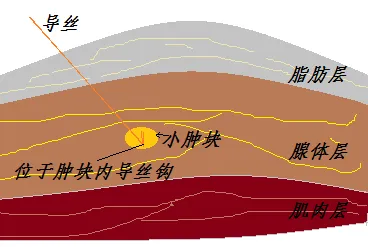 乳腺定位针怎么放新技术上线 ｜ 让早期乳腺癌无处遁形——超声引导下导丝定位“捕捉”乳腺小结节_https://www.jmylbn.com_新闻资讯_第6张