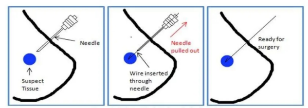 乳腺定位针怎么放新技术上线 ｜ 让早期乳腺癌无处遁形——超声引导下导丝定位“捕捉”乳腺小结节_https://www.jmylbn.com_新闻资讯_第5张